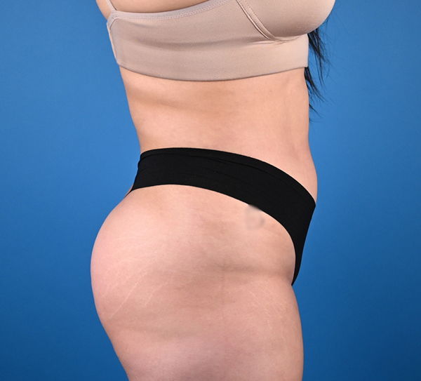 Liposuction