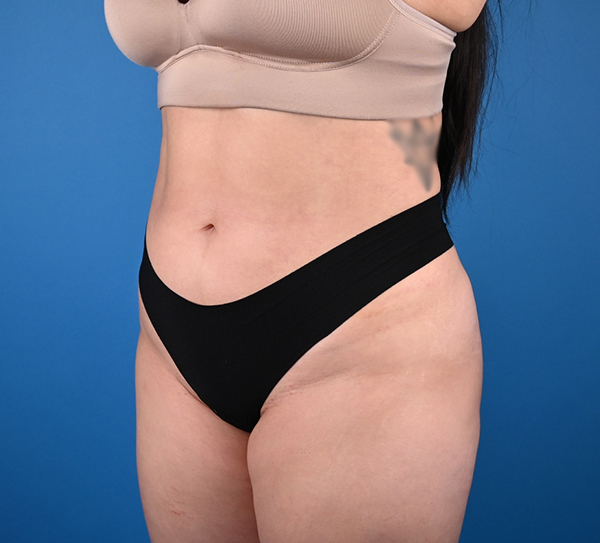 Liposuction