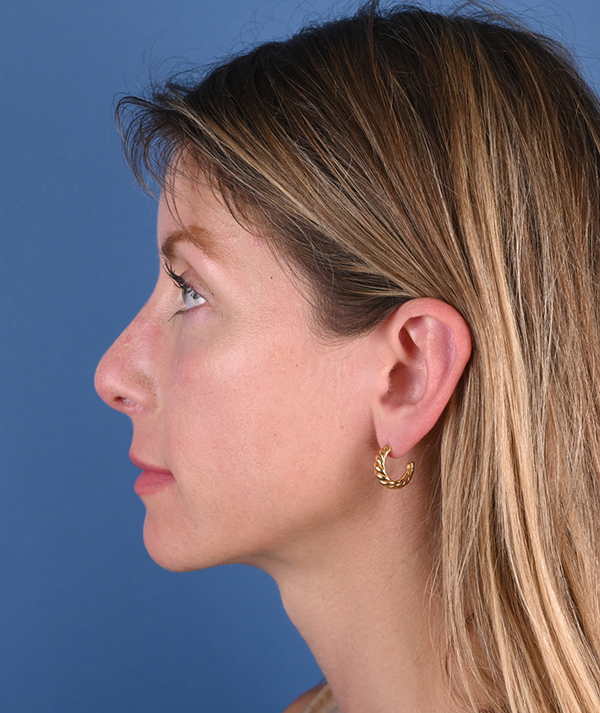 Revision Rhinoplasty