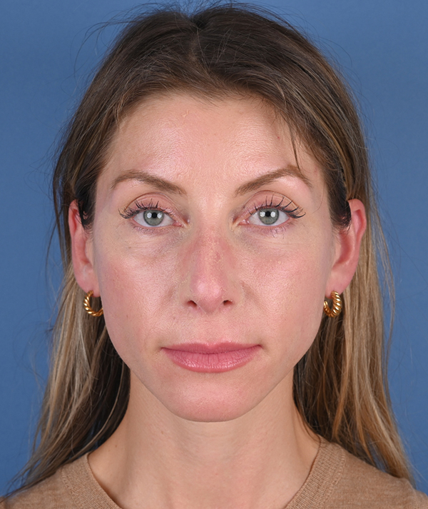 Revision Rhinoplasty Before and After