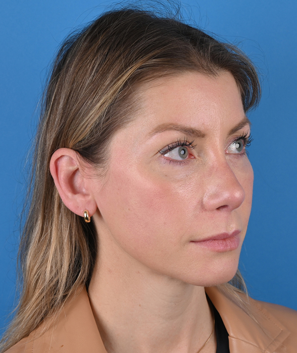 Revision Rhinoplasty