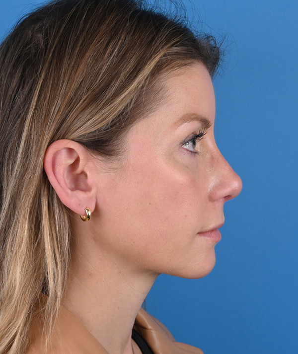 Revision Rhinoplasty