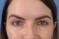 Blepharoplasty