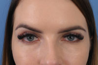 Blepharoplasty