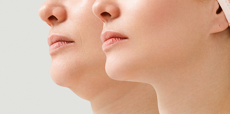 Genioplasty or Chin Augmentation Surgery Chicago