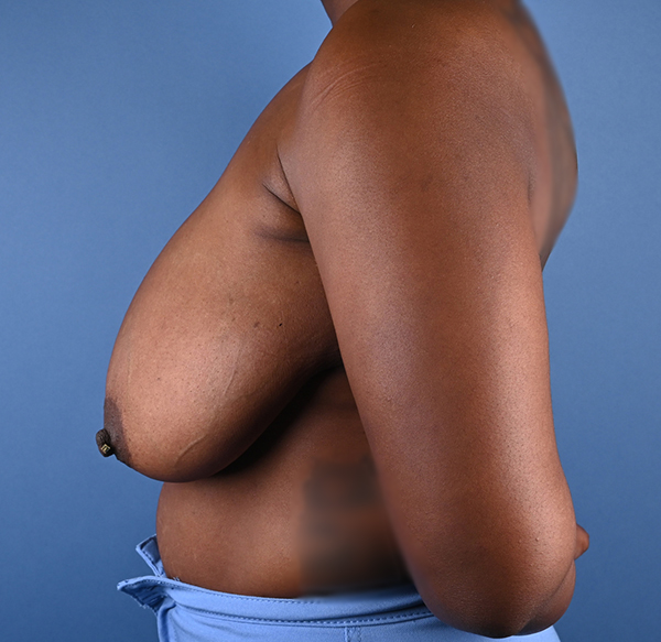 Breast Reduction