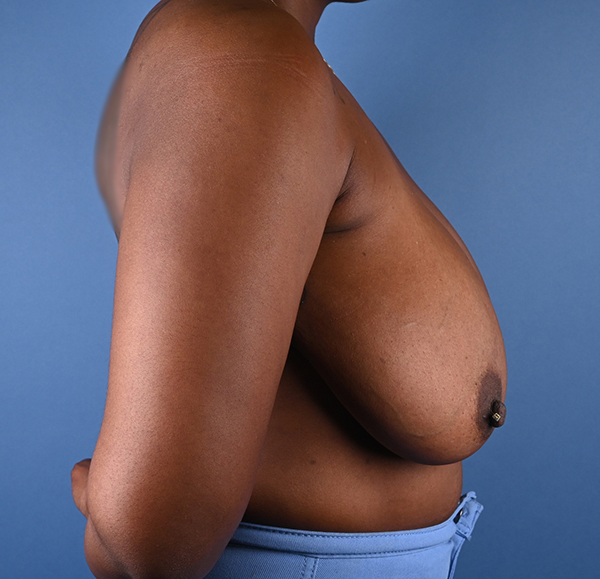 Breast Reduction
