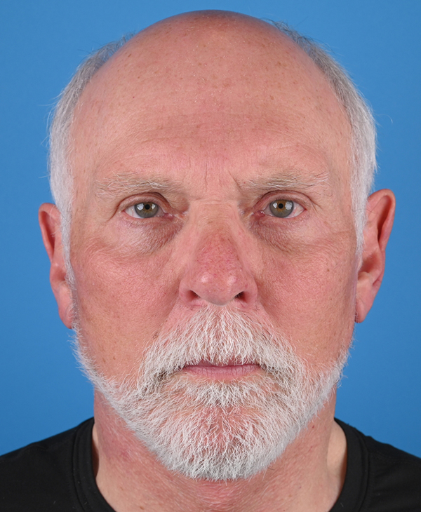 Male Facelift