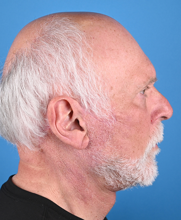 Male Facelift