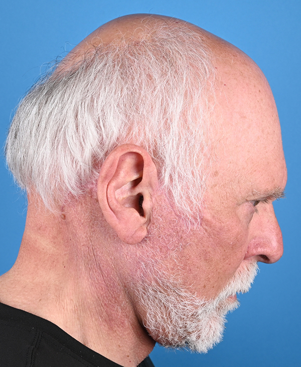 Male Facelift