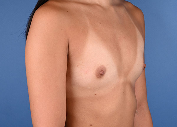 Breast Augmentation