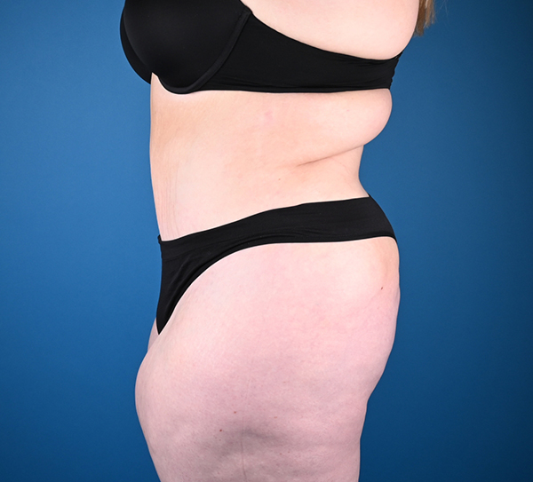 Abdominoplasty