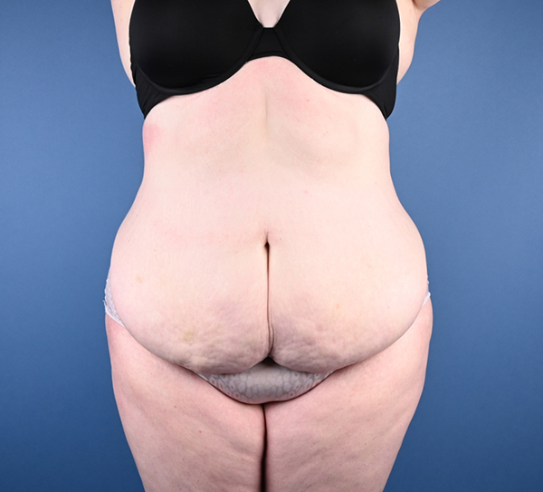 Abdominoplasty