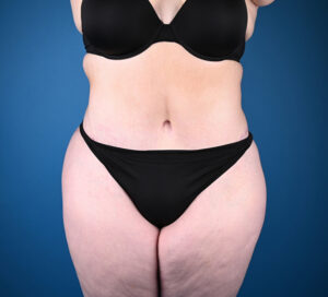 Abdominoplasty