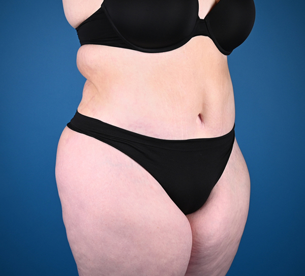 Abdominoplasty