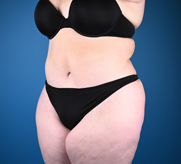 Abdominoplasty