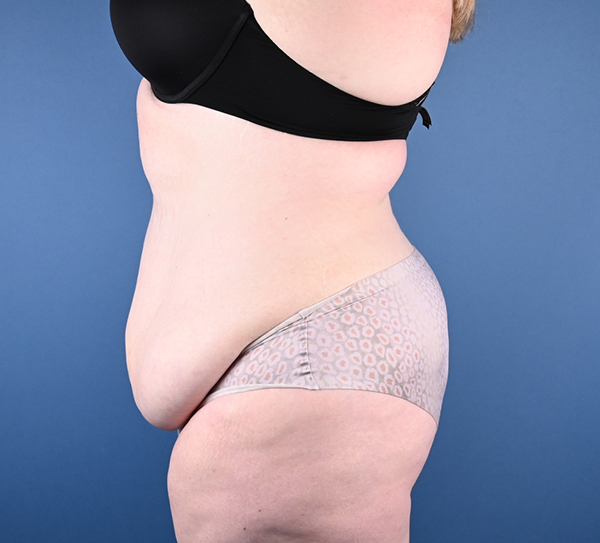 Abdominoplasty