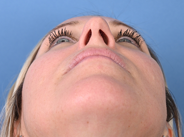 Rhinoplasty