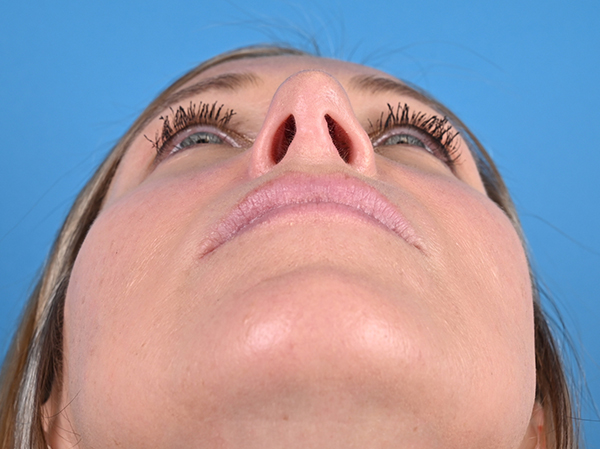 Rhinoplasty