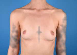 Before breast augmentation Front View