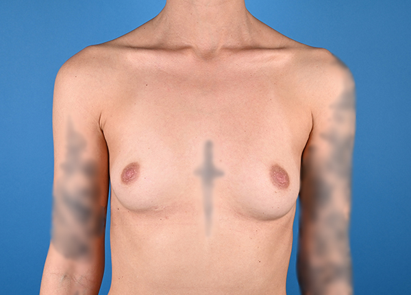 Breast Augmentation