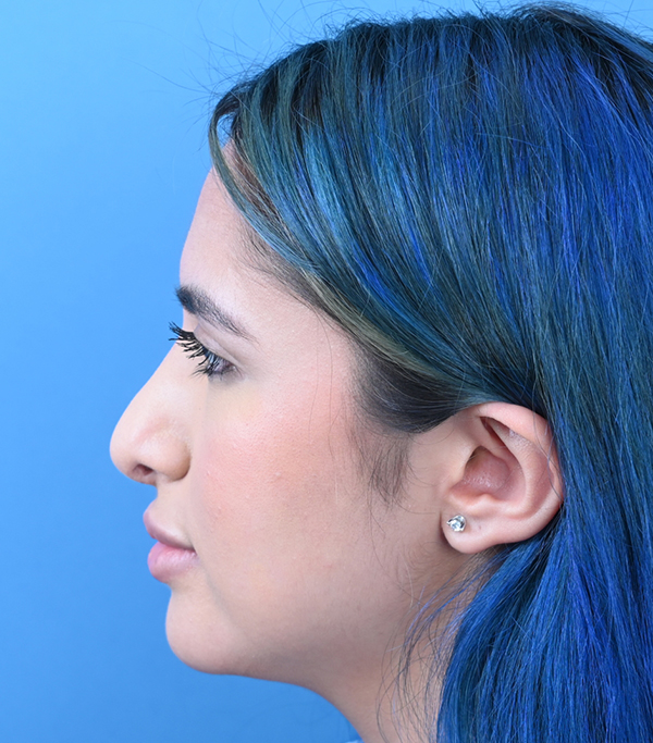 Revision Rhinoplasty