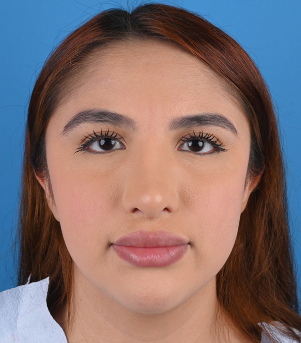 Revision Rhinoplasty