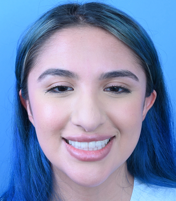 Revision Rhinoplasty