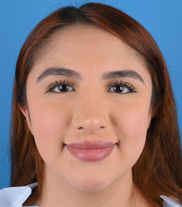 Revision Rhinoplasty