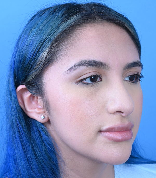 Revision Rhinoplasty