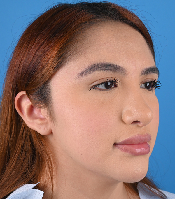 Revision Rhinoplasty