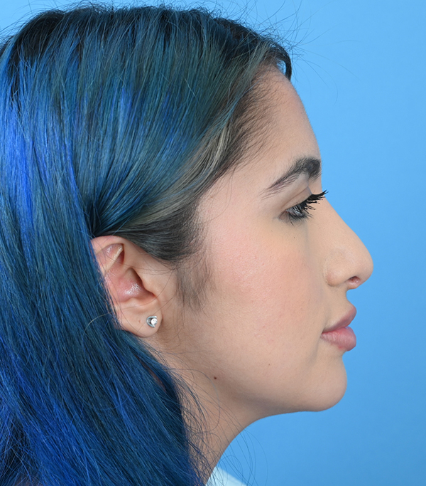 Revision Rhinoplasty