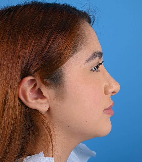 Revision Rhinoplasty