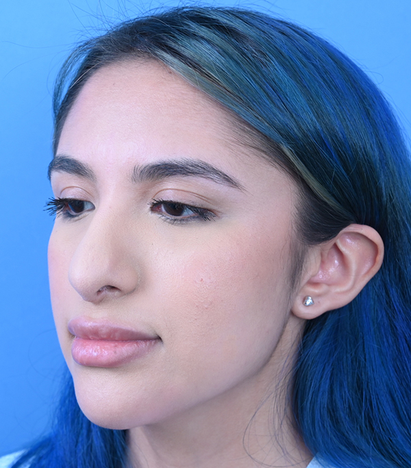 Revision Rhinoplasty