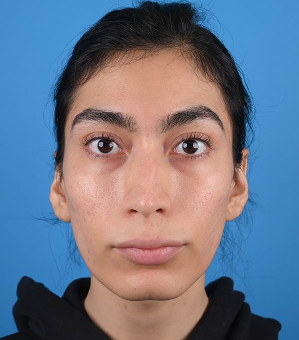 Facial Feminization Before and After