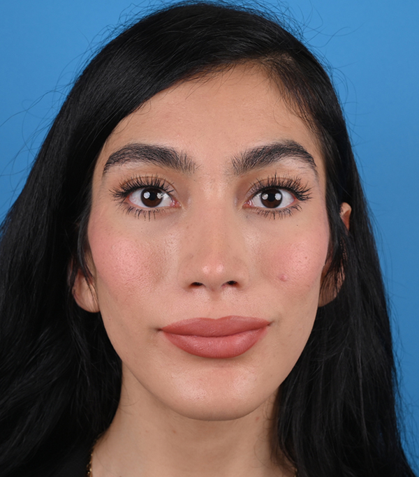 Facial Feminization Before and After