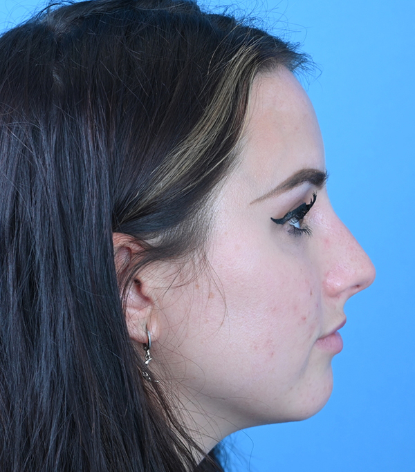 Rhinoplasty