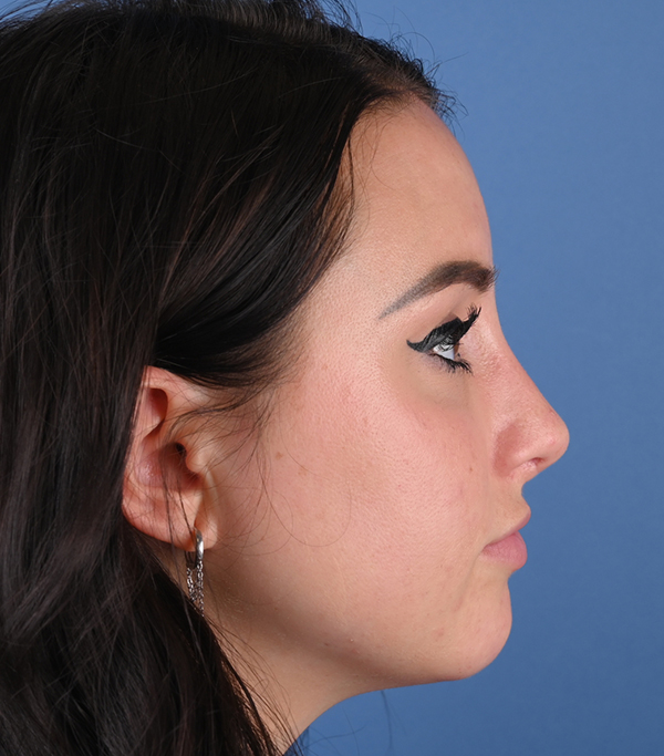 Rhinoplasty