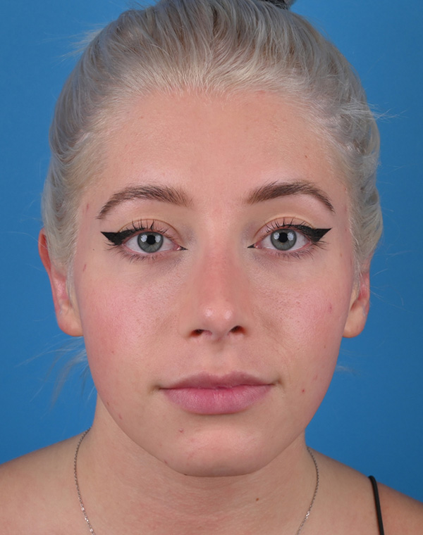 Otoplasty Before and After