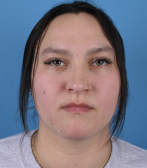 After rhinoplasty and genioplasty Front View