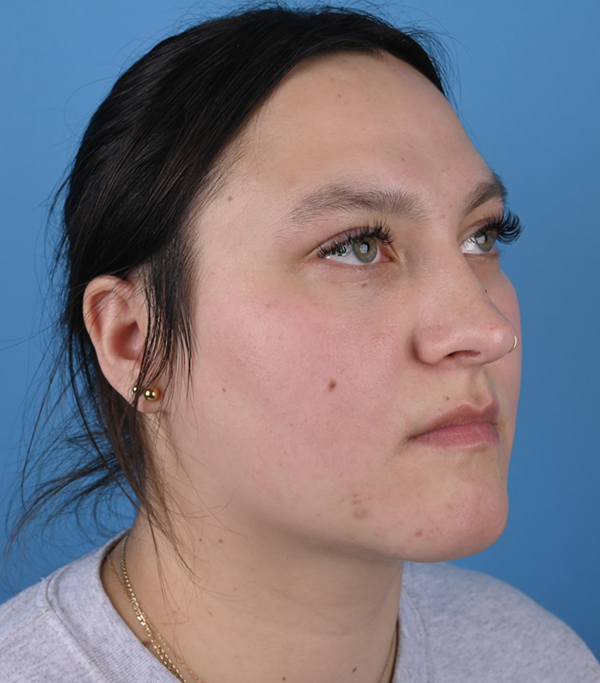 Genioplasty