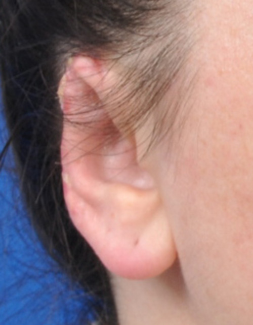 Ear Reconstruction