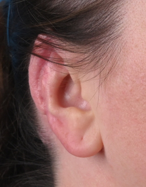 Ear Reconstruction