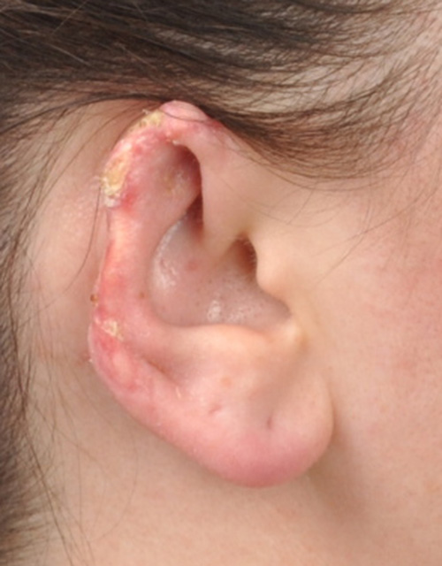 Ear Reconstruction