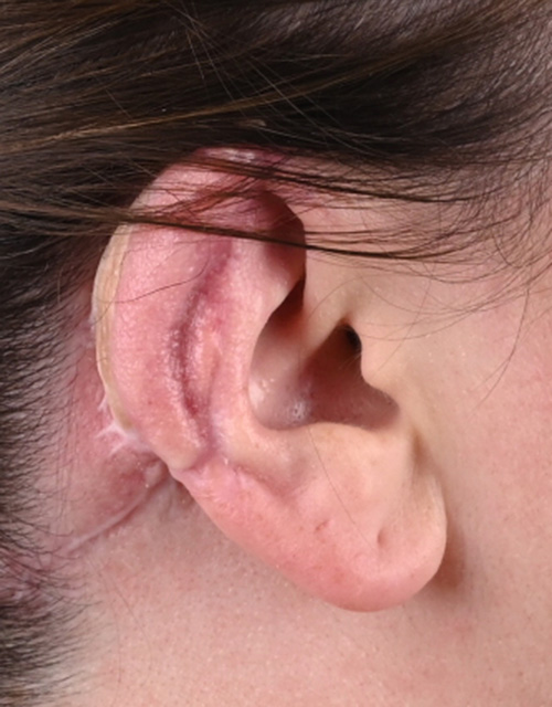 Ear Reconstruction