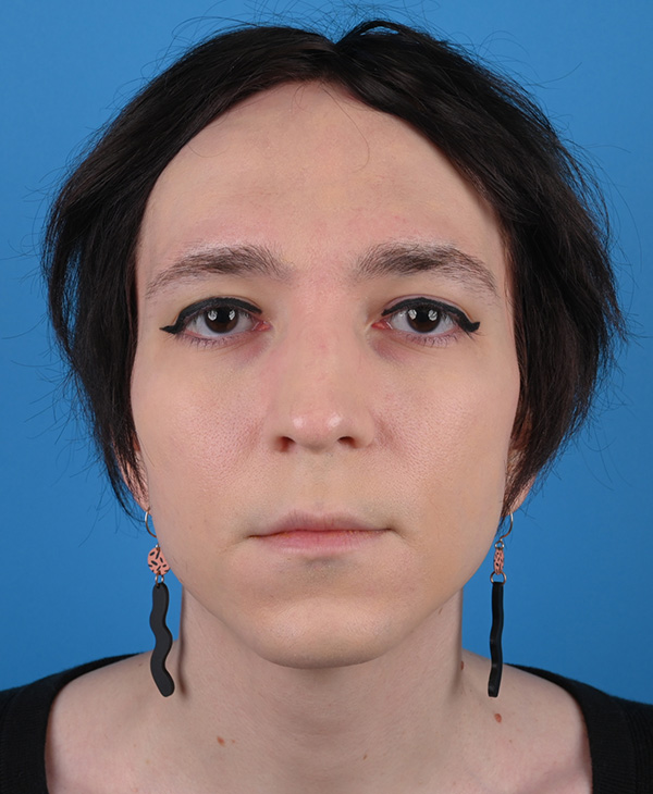 Rhinoplasty