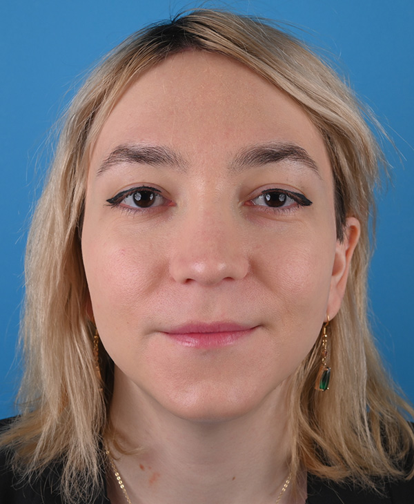 Rhinoplasty