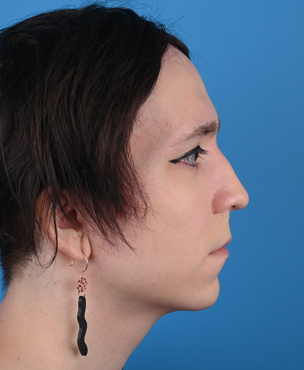 Rhinoplasty