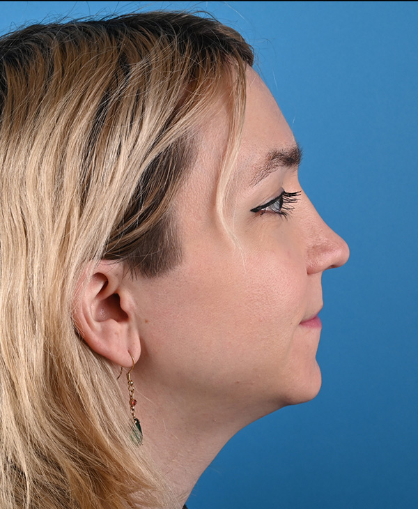Rhinoplasty