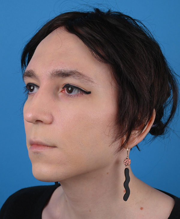 Rhinoplasty